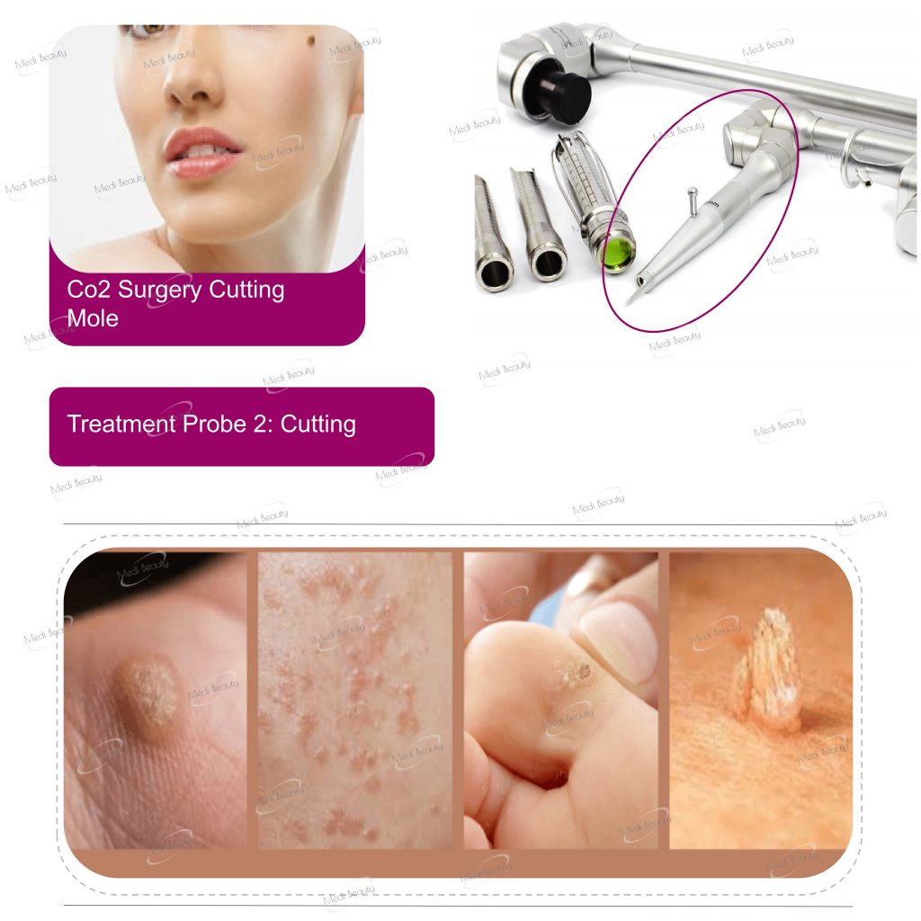 CO2 Laser Fraction for Skin Resurfacing Tightening