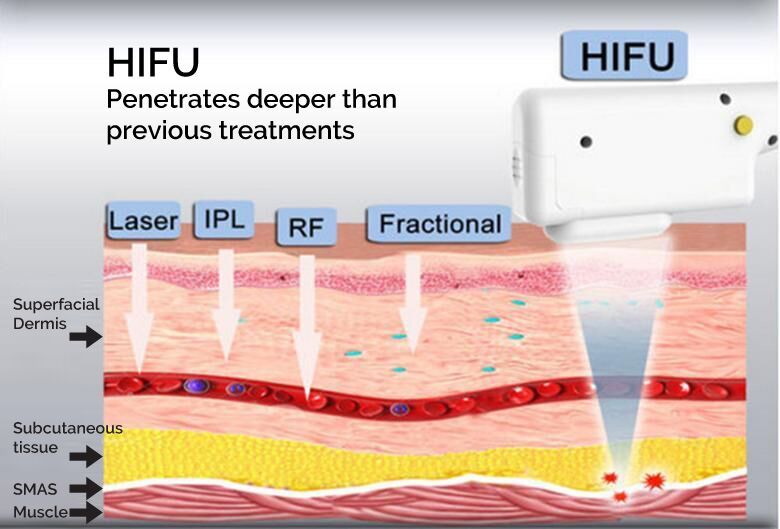 7D HIFU Face lifting tightening body contouring