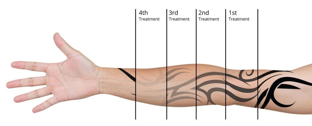 NdYag 755 1064 532 Tattoo Removal Pico
