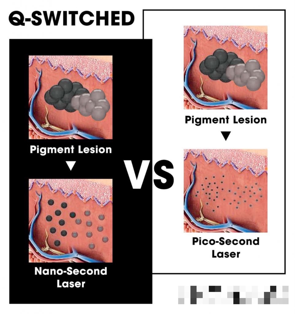 NdYag 755 1064 532 Tattoo Removal Pico
