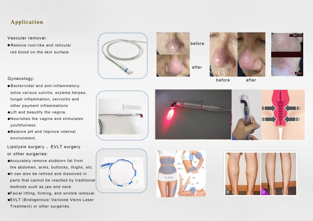 980nm 3 in 1 endo laser lipolysis